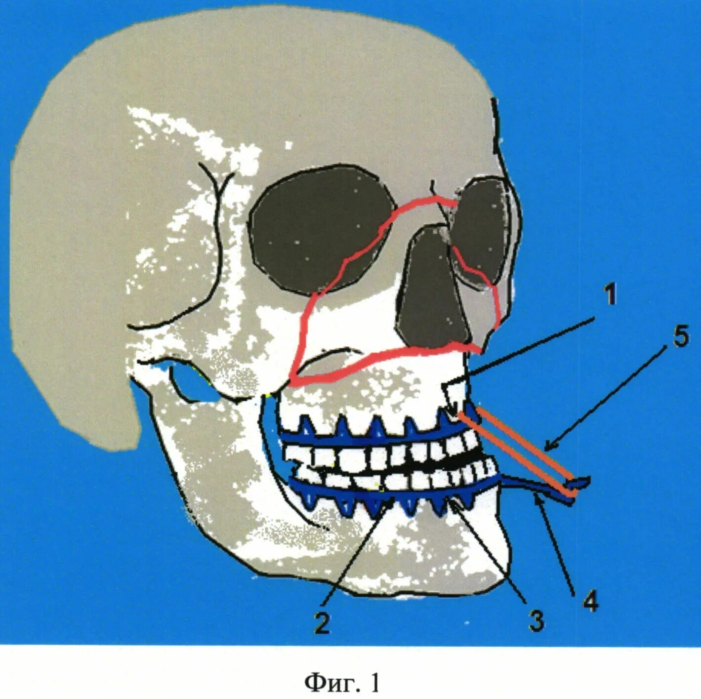 Переломы средней зоны лица. Перелом костей лицевого скелета. Переломы костей средней зоны лица.