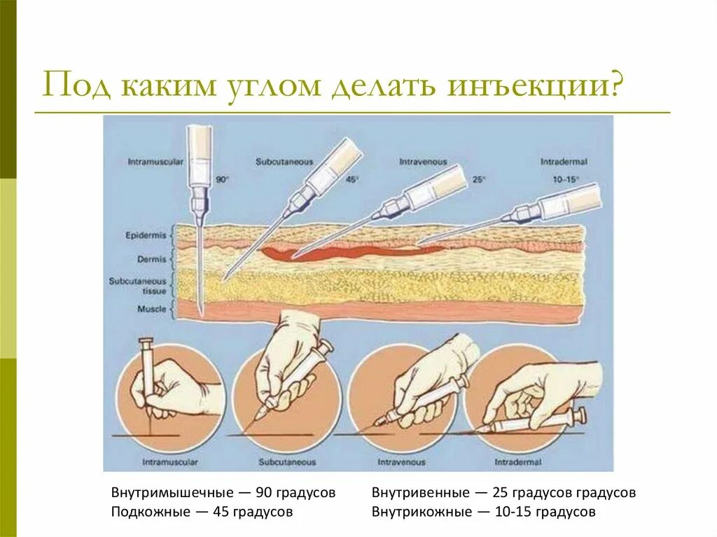 Внутрикожная инъекция угол наклона иглы. Внутримышечная инъекция угол введения иглы. Схема выполнения внутрикожной инъекции.