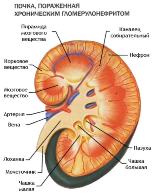 Почка пораженная гломерулонефритом. Гломерулонефрит почечный клубочек. Поражение клубочков гломерулонефрит. Гломерулонефрит, нефрозонефрит.. Поражение клубочков почек