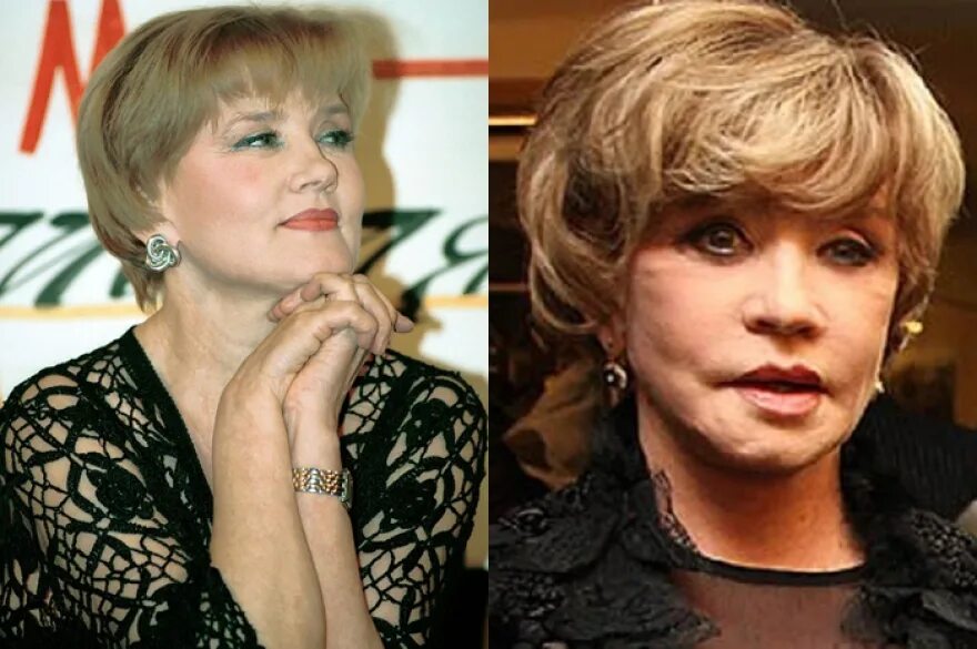 вера алентова пластика. вервалентова после пластики. вера алентова неудачная пластика. вера алентова пластическая операция. вера алентова после пластической операции.