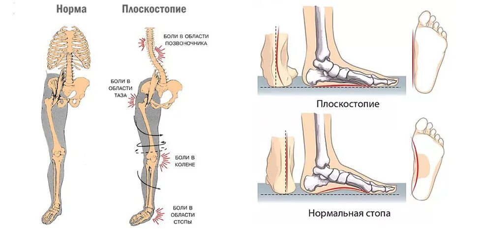 Нарушения стопы. Продольно-поперечное плоскостопие и вальгус 3 степени. свод стопы плоскостопие анатомия. скелет стопы при плоскостопии. плоскостопие поперечного свода стопы.