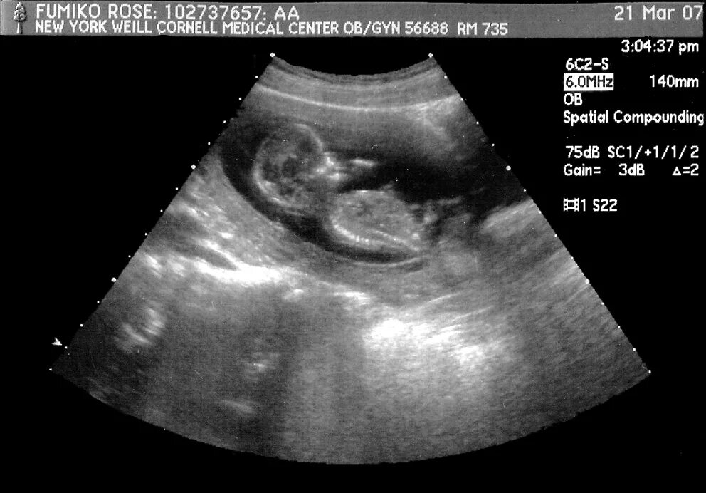 12 неделя ощущения. УЗИ 12 недель беременности. Эмбрион на 12 неделе беременности УЗИ. Снимки УЗИ беременности 12 недель. Плод на 12 неделе беременности фото плода на УЗИ.