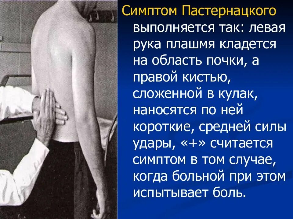 Пальпация живота щеткина блюмберга. Симптомы ортнера василенко захарьина. Острая кишечная непроходимость симптом щеткина-блюмберга. Симтом щетуина блюмбеонп. Симптом ортнера, керра, щёткина блюмберга.