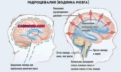 Как лечить черепной