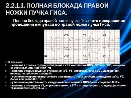 Блокада ножки гипса