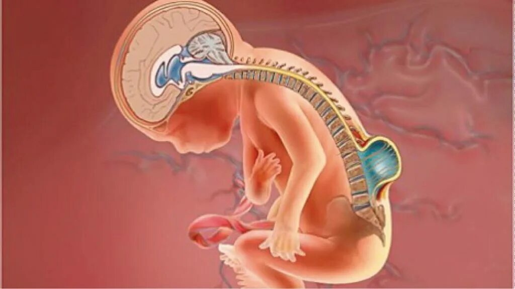 Внутриутробное недоразвитие головного мозга. Миеломенингоцеле (spina Bifida cystica). Спинномозговая грыжа spina Bifida. Внутриутробная хирургия плода. Пороки развития нервной трубки.