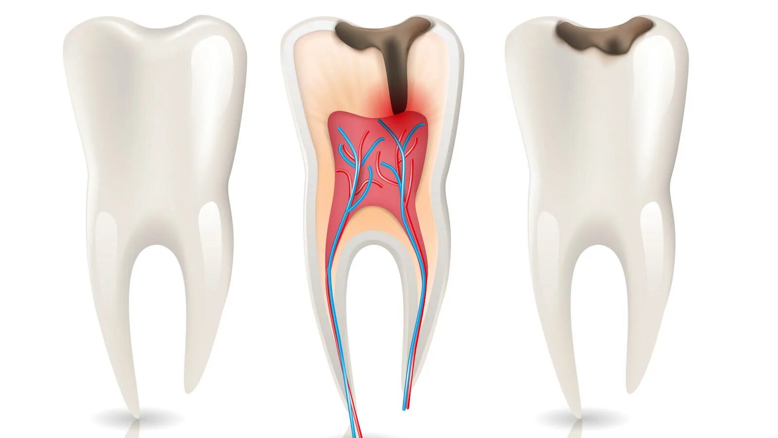 Root canal. Двухсторонний пульпит.