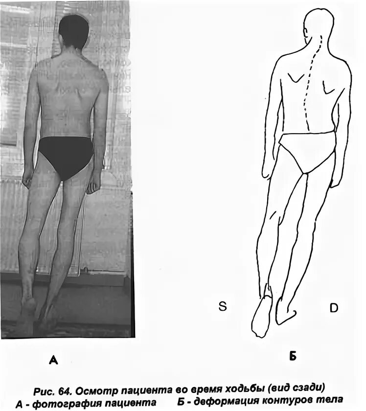 Укорочение трубчатых. Укорочение нижней конечности. Деформация контуров тела при укорочении грудной мышцы. Синдром нижней косой мышцы. Постурология.