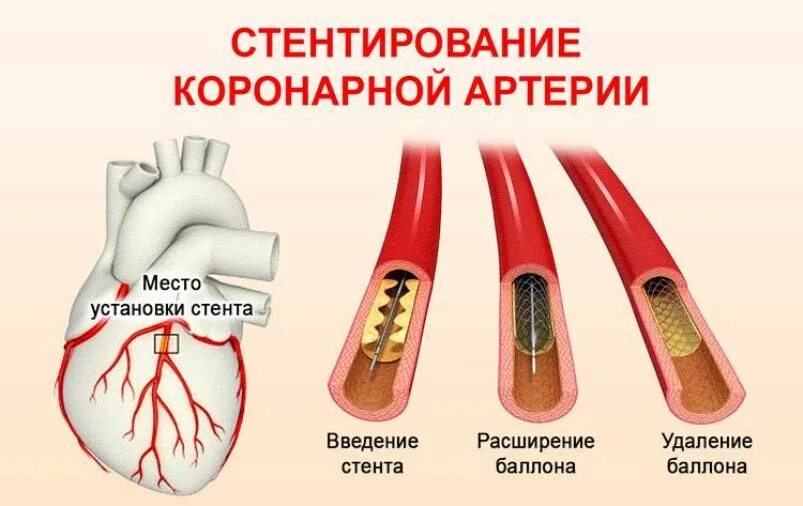 Операции коронарных артерий. Операция при инфаркте стентирование. Инфаркт миокарда операция стент. Операция стентирования сосудов сердца при инфаркте. Схема стентирования сосудов сердца.