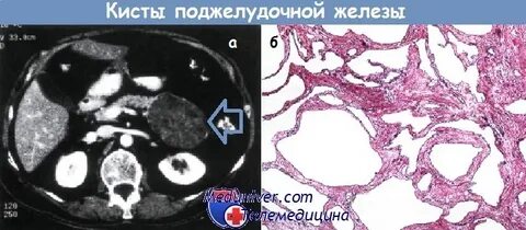 Кистозно солидное образование поджелудочной железы
