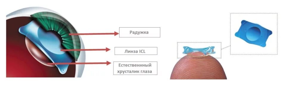 Линзы в глаза операция