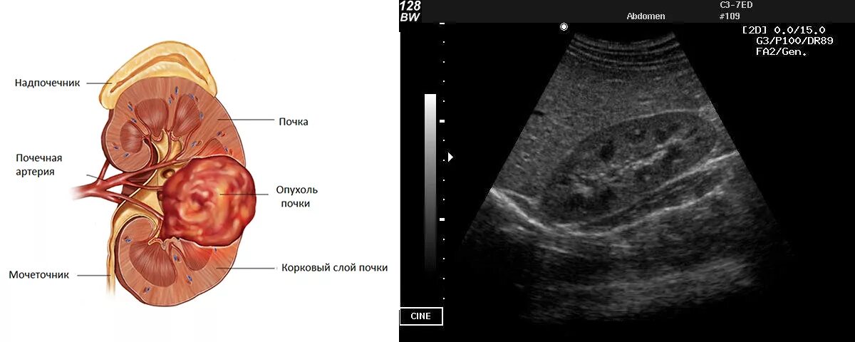 Узи почек диагнозы. УЗИ почек, мочеточников, надпочечников. Хронический гломерулонефрит УЗИ почек. УЗИ почек и мочевого пузыря сердце. Пиелонефрит УЗИ почек норма.