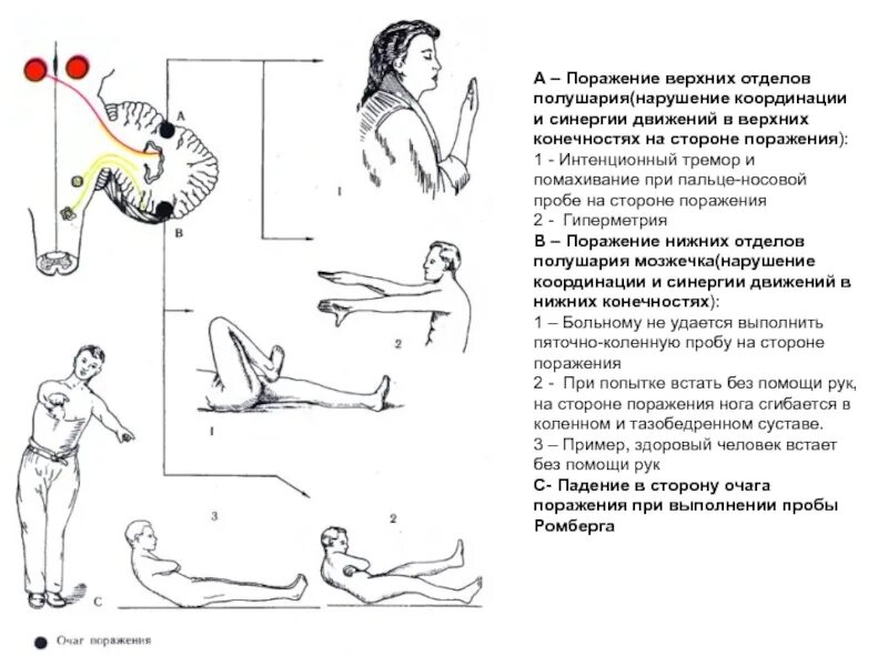 Что происходит при повреждении мозжечка. Пробы при поражении мозжечка. при поражении правого полушария мозжечка нарушаются движения в. интенционный тремор при поражении мозжечка. при поражении левого полушария мозжечка наблюдаются.