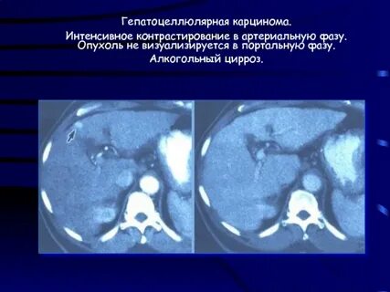 Гиповаскулярное образование в печени на кт