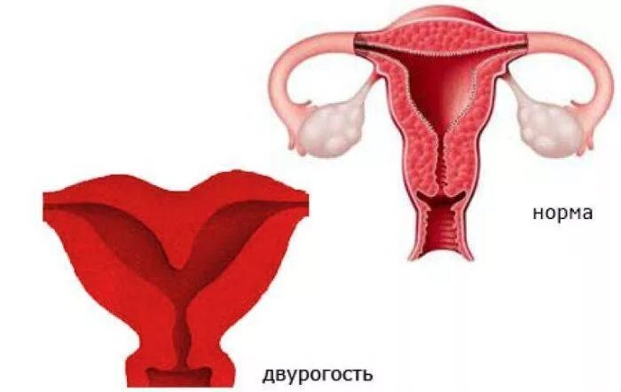двухроговая матка у женщин. двухроговая матка у женщин. двурогая седловидная матка. двурогая матка и беременность. аномалия матки двурогая.