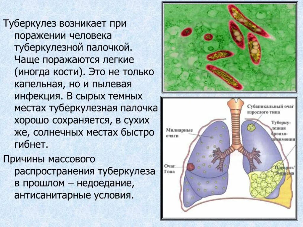 Туберкулез легких презентация. Презентация на тему туберкулез легких.