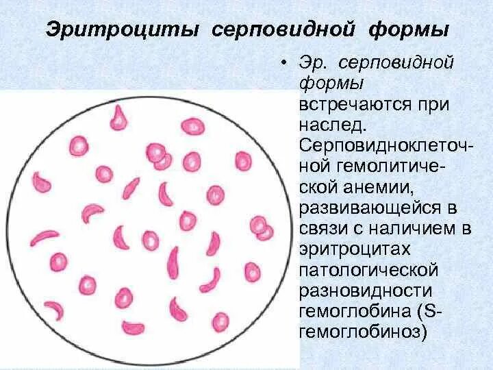 Пониженные макроциты. Картина крови при серповидноклеточной анемии. Серповидноклеточная анемия эритроциты. Серповидноклеточная анемия мазок. Эритроциты мазок гипохромия.