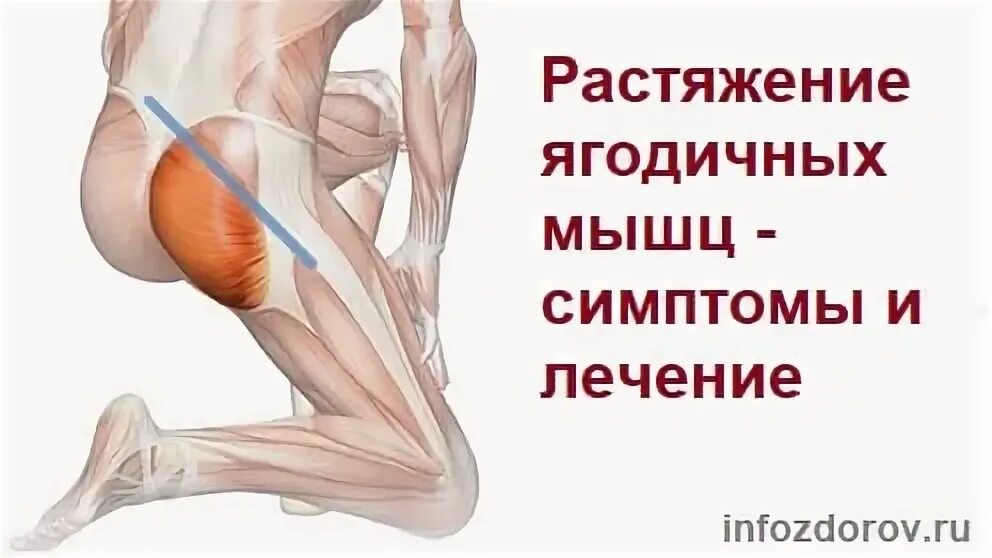 Признаки разрыва мышц. Тендинит ягодичных мышц симптомы. растяжение мышц ягодиц. надрыв ягодичной мышцы.