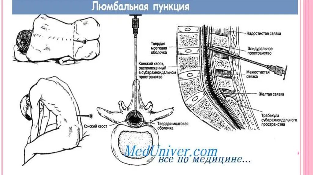 Люмбальная пункция между. Проведение люмбальной пункции алгоритм. Люмбальная пункция позвонки. Люмбальная пункция анатомия.