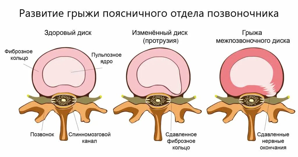 Какой врач лечит протрузии