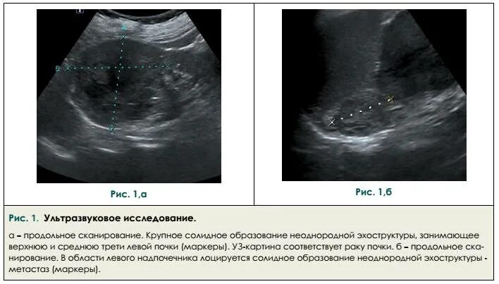 Опухоль почки УЗИ признаки. Опухоль почки снимок УЗИ. Злокачественные образования почки на УЗИ. Почечно клеточная карцинома на УЗИ.