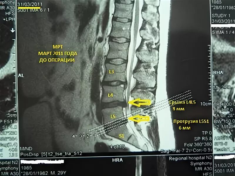Диски l5-s1 в позвоночнике. Грыжа l3-l4. Грыжа диска l4 s1 операция. Грыжа межпозвонкового диска операция.