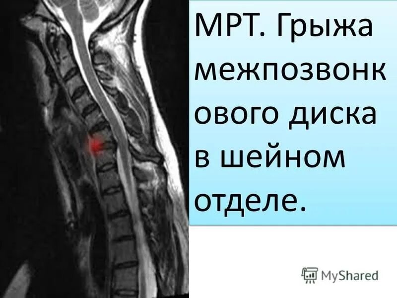 Грыжа в шейном отделе мрт. Грыжа шейного отдела позвоночника мрт.