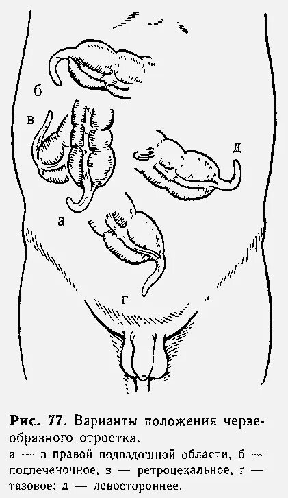 Локализация червеобразного отростка. Подпеченочное расположение червеобразного отростка. Левостороннее расположение червеобразного отростка. Расположение червеобразного отростка у детей. Локализация острого аппендицита