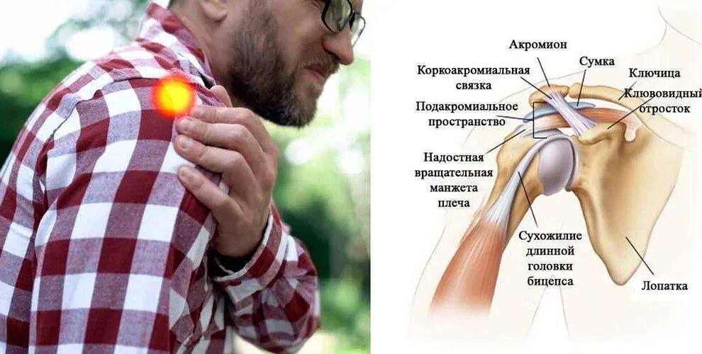 Боли мышц предплечья как лечить. Боль в плечевом суставе. боли в плечевом суставе плече. болит плечевой сустав правой руки. капсулит плечевого сустава.