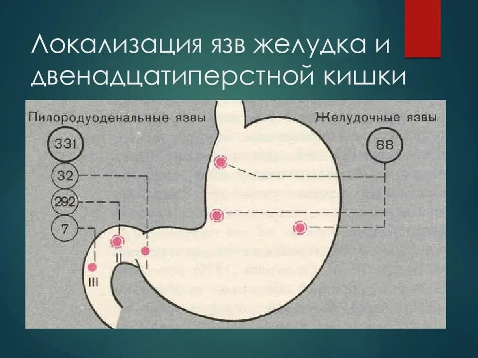 Язва желудка и 12 перстной кишки. Локализация язвы двенадцатиперстной кишки. Классификация язв желудка по локализации. Язвенная болезнь 12 перстной кишки классификация. Локализация боли желудка