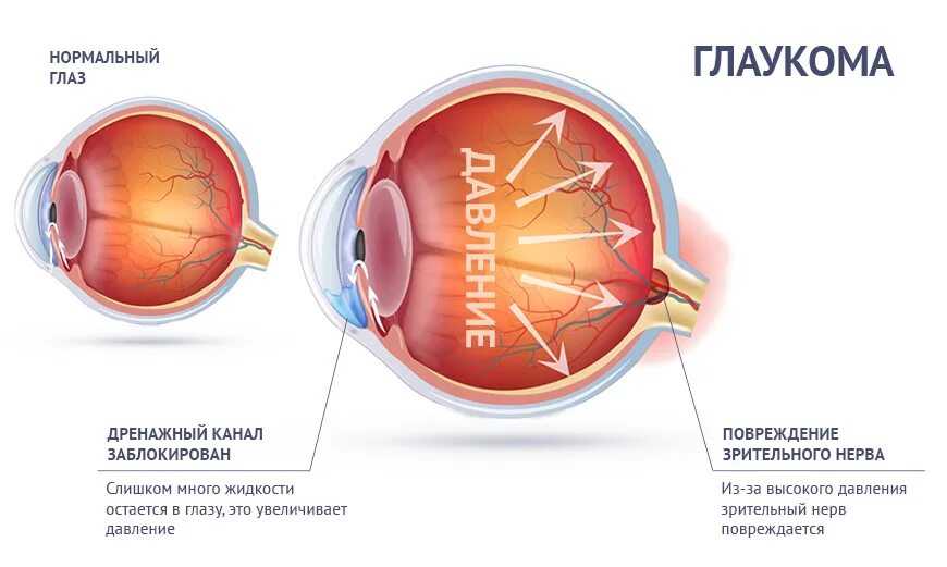 Глазные болезни: глаукома, катаракта. Глаукома схема глаза. Глаукома плакат. Строение глаза при глаукоме. Причины глаукомы глаза