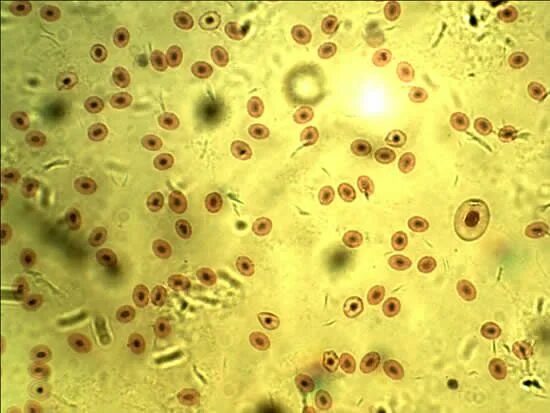 Blood Cells In Urine : Biological Science Picture Directory - Pulpbits.net