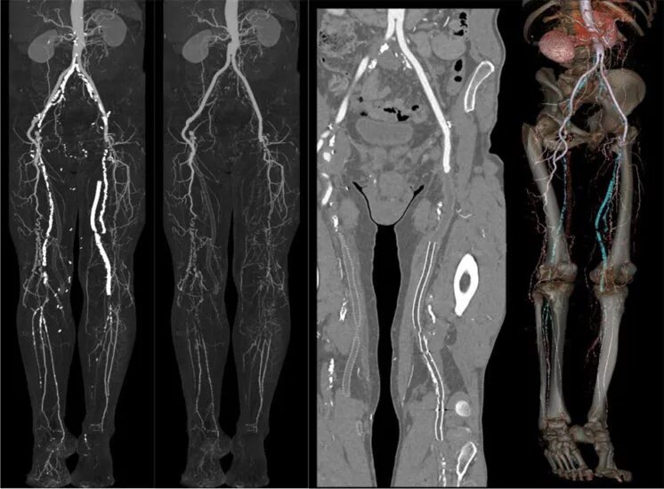 Нижних конечностей и головного мозга. Кт ангиография сосудов нижних конечностей. Кт флебография нижних конечностей. МСКТ-ангиография артерий нижних конечностей. МСКТ ангиография сосудов нижних конечностей.