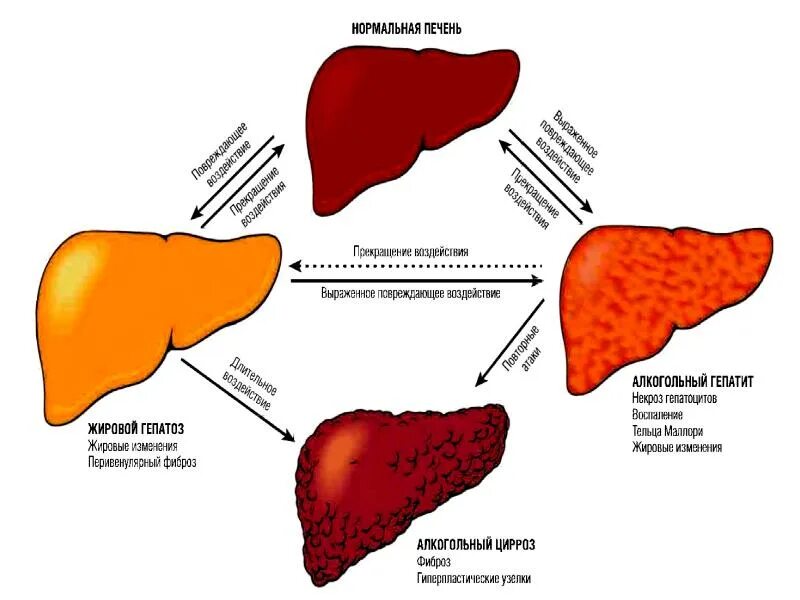 Печень воняет. Патогенез цирроза печени. Механизм развития цирроза печени. Патогенез цирроза печени патофизиология. Портальный цирроз этиология.