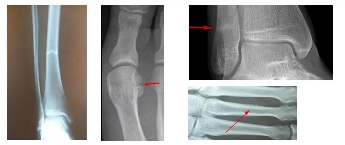 Перелом спустя неделю. Стрессовый перелом большеберцовой кости рентген. Стресс перелом большеберцовой кости рентген. Костная мозоль плюсневой кости. Стрессовый перелом большеберцовой кости симптомы.
