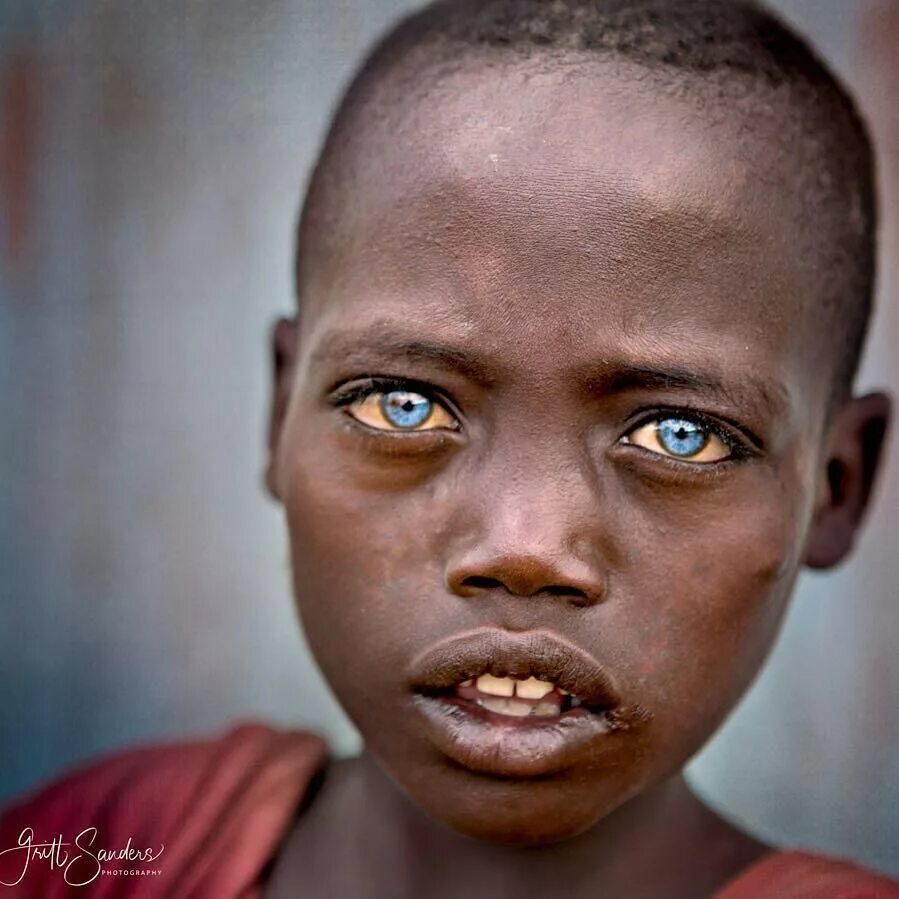 Глаза чернокожих. Альбинос негроидной расы. Альбинизм негроидная раса. Эфиопы с голубыми глазами. Голубоглазые африканцы.