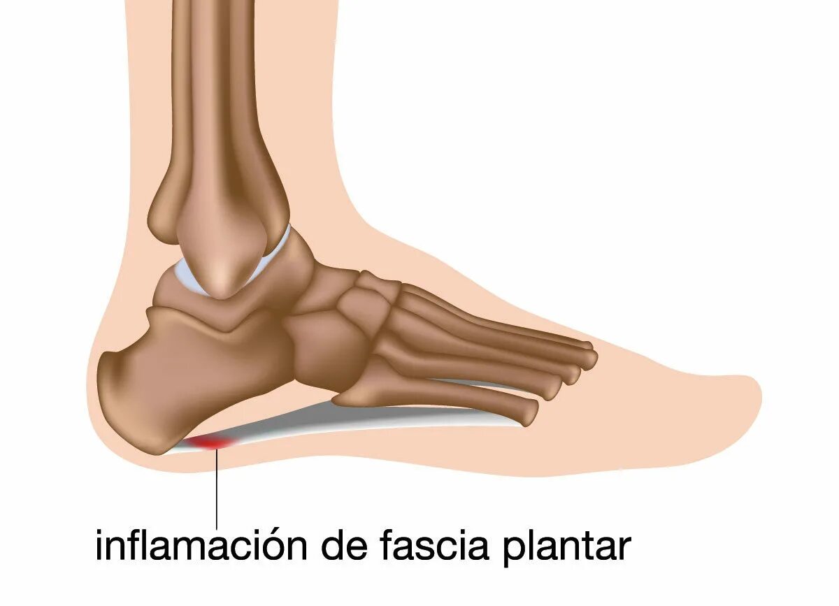 Фасцит в пятке. Ахиллобурсит сухожилия. Воспаление плантарный фасциит. Плантарный фасциит стопы. Тендопатия ахиллесова сухожилия.