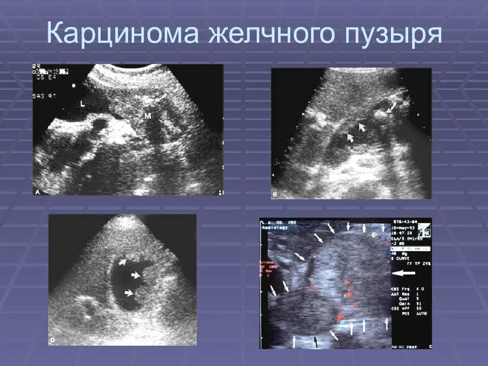 Отек желчного пузыря. УЗД опухолей желчного пузыря. Карцинома желчного пузыря УЗИ. Новообразование в желчном пузыре на УЗИ. Полипоз желчного пузыря на УЗИ.