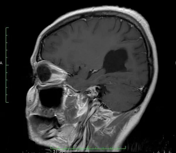 После операции менингиомы головного мозга. Невринома гассерова узла мрт. Невринома тройничного нерва мрт. Невринома опухоль в голове. Тройничный нерв на мрт головного мозга.