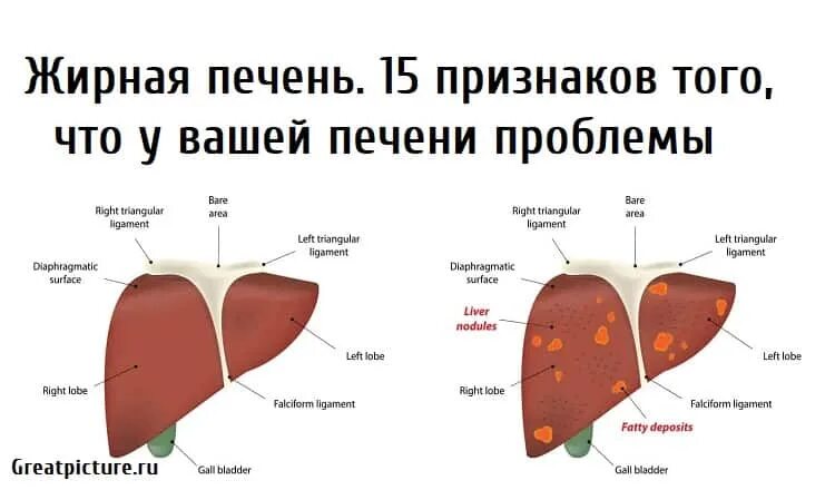 Как отличить печень. Печень здоровая и больная. Проблемы с печенью симптомы. Печень здорового человека и больного.