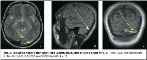 Синус тромбоз диагностика