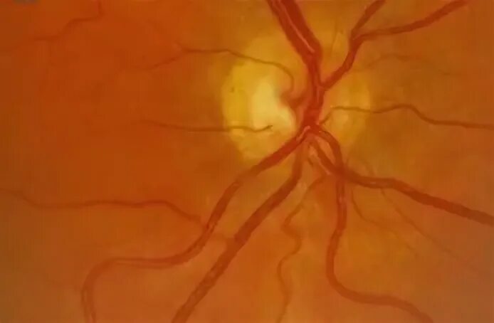 Аномалия развития зрительного нерва. Гипоплазия зрительного нерва. Гипоплазия диска зрительного нерва. Гипоплазия зрительных нервов.
