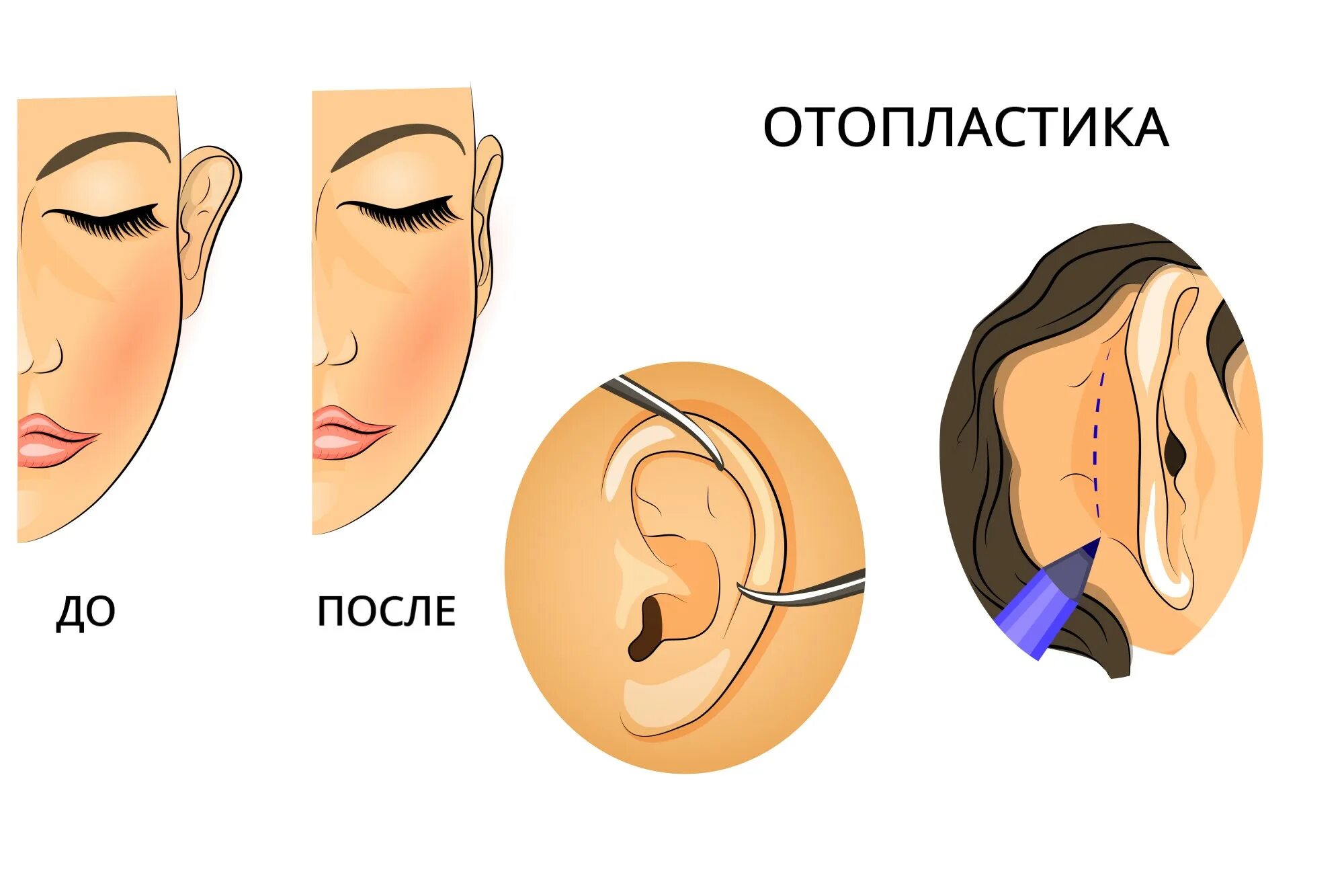 Как делается операция уха. Пластическая хирургия ушей. пластическая операция уха. отопластика операция на уши.