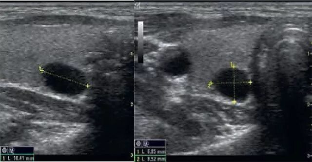 Лимфоузел неоднородный. Щитовидная железа узелок на УЗИ. Анэхогенный узел щитовидной железы. Загрудинный узел щитовидной железы . УЗИ.