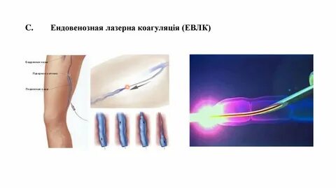 Облитерация это