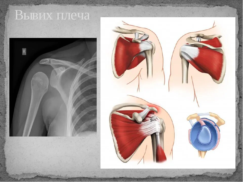 Плечелопаточный сустав,вывих. Нижнемедиальный вывих плеча. Вывих головки плечевой кости. Подклювовидный вывих плеча. Повреждения правого плечевого сустава