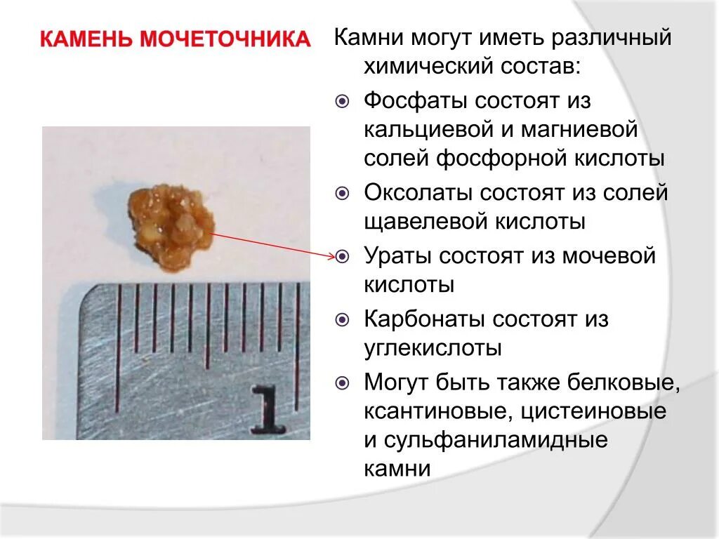 Камни из мочевой кислоты. Камни мочевой кислоты в почках. Ураты камни в моче. Камни из солей мочевой кислоты это.