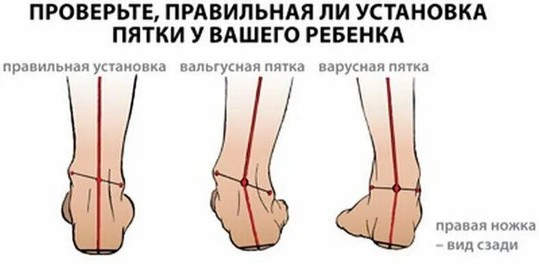 Как лечат вальгусную стопу у ребенка