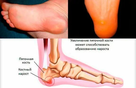 Почему болит пятка у ребенка. Болит пятка сбоку с внутренней стороны.