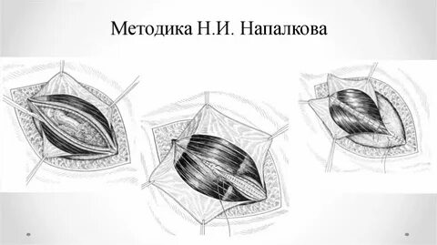 Пупочная герниопластика